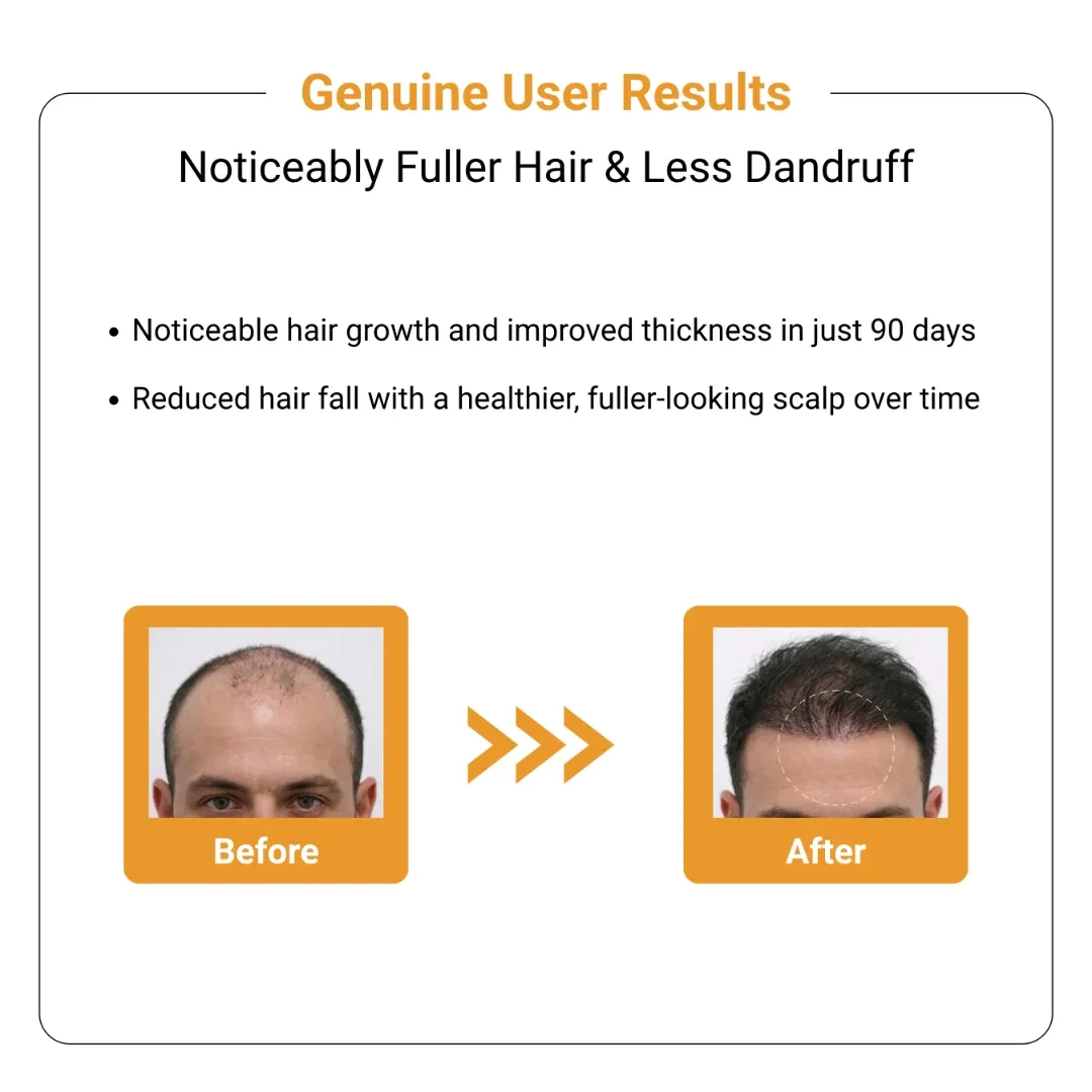 Minoxidil 5% Hair Growth Solution (60ml) - Minoxra Topical Solution 6